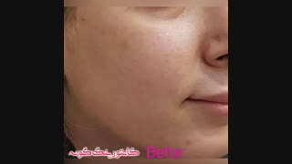 فیلم واقعی قبل و بعد کانتورینگ گونه