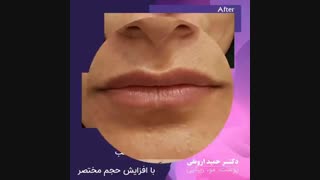 فیلم مدلینگ لب با افزایش حجم مختصر