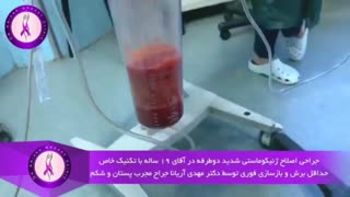 جراحی ژنیکوماستی شدید در آقای 19 ساله