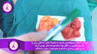 جراحی اصلاح ژنیکوماستی شدید