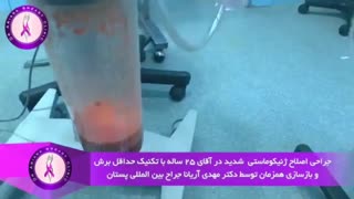 جراحی اصلاح ژنیکوماستی شدید در آقای 25 ساله
