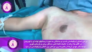 بزرگی شدید پستان ها در مرد 35 ساله