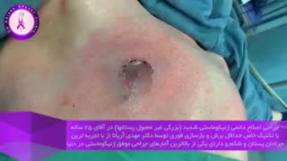 اصلاح دائمی ژنیکوماستی شدید