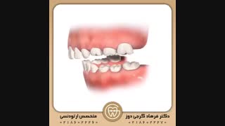 بایونیتور یک دستگاه ارتودنسی با عملکرد فانکشنال است | دکتر فرهاد گرجی دوز