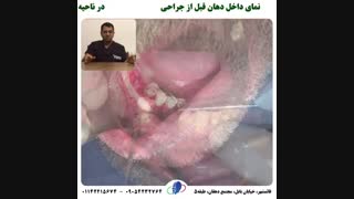 بازسازی ایمپلنت شکست خورده