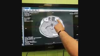 کیس انسفالوسل تروماتیک