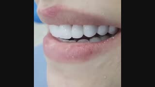 لمینت تمام سرامیکی دندان