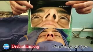 جراحی انحراف بینی توسط دکتر امید ابراهیمی بهترین جراح بینی در تهران