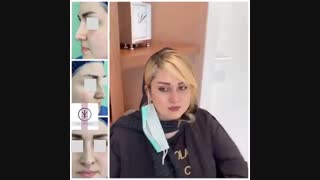 سه ماه بعد از جراحی زیبایی بینی غضروفی - استخوانی