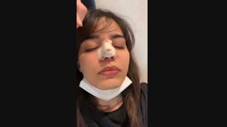 فیلم چسب زدن بینی گوشتی