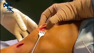 جراحی در رفتگی مکرر کشکک  زانو