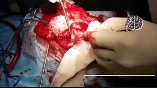 فیلم واقعی  جراحی تومور مغزی