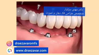 جویدن با ایمپلنت