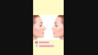 مراقبت های بعد از رینوپلاستی