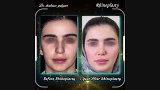 قبل و بعد از جراحی بینی