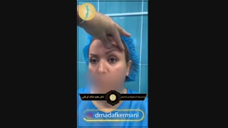 جراحی لیفت ابرو و از بین بردن خط اخم  با آندوتاین