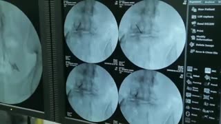 جراحی بالیزر فست برای درمان دیسک کمر