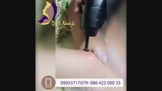 فیلم واقعی محو شدن جای زخم و اسکار با لیزر CO2