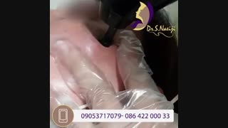فیلمی باور نکردنی از برداشتن خال با لیزر CO2