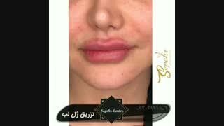 تزریق ژل لب با متد روسی