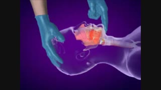 باز کردن راه هوایی