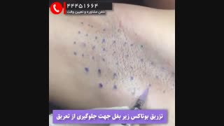 تزریق بوتاکس زیر بغل جهت جلوگیری از تعریق