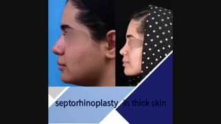 فیلم عمل بینی گوشتی با پوستی ضخیم