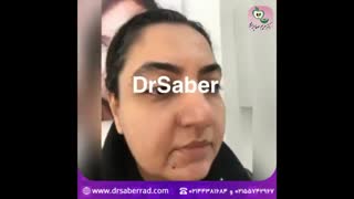 اراف فرکشنال جهت جوانسازی پوست