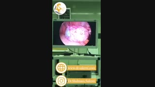 لاپاراسکوپی خارج کردن کیست درمویید