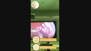 لاپاراسکوپی خارج کردن فیبروم رحم