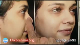 عمل بینی گوشتی پهن توسد دکتر امید ابراهیمی بهترین جراح بینی در تهران