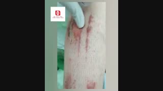 آموزش درمان سوختگی با آب جوش از نوع گرید 2 عمیق