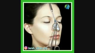 انیمیشن جراحی بینی