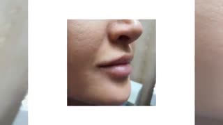 فیلم نمونه واقعی تزریق ژل لب طبیعی