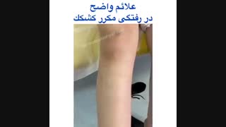 نشانه های در رفتگی کشکک زانو