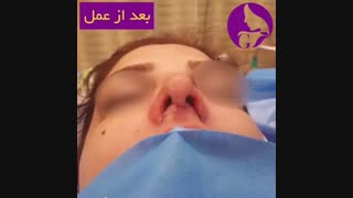 بلافاصله بعد از عمل بینی