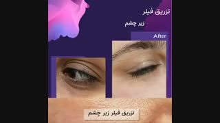 فیلم واقعی تزریق فیلر زیر چشم