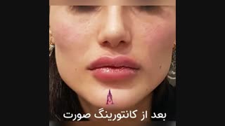 فیلم واقعی کانتورینگ صورت با تزریق فیلر هیالورونیک اسید