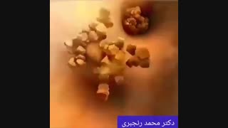 نحوه تشکیل و گیر افتادن سنگ های کلیوی در مسیر حالب