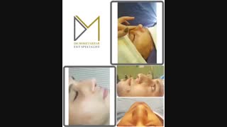 فیلم سه هفته پس از جراحی زیبایی بینی