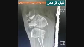 فیلم جراحی شکستگی شدید زانو