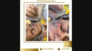 فیلم واقعی از روند جوانسازی صورت با لیزر فرکشنال