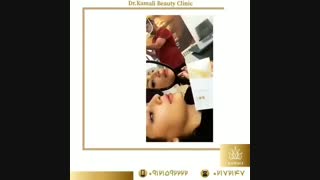 فیلم نتیجه زیبای تزریق 1 سی سی ژل به لب