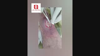 آموزش دبرید و پانسمان زخم سوختگی با سلولیت وسیع