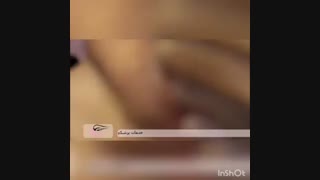 رفع چین و چروک مزوتراپی