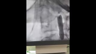 تنگی شدید کاروتید داخلی نزدیک به 100 درصد در بیمار کاندید CABG