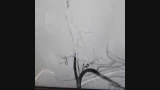 جراحی بسته تومور نخاعی از طریق آنژیوگرافی