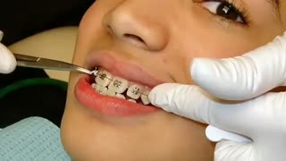 آیا در درمان ارتودنسی و نصب براکتها احتیاجی به تزریق بی حسی است ؟ | دکتر سعید قریشی