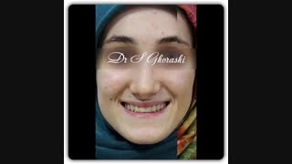 درمان بدون کشیدن و بدون جراحی بیمار با ناهنجاری کلاس ٣ | دکتر سعید قریشی