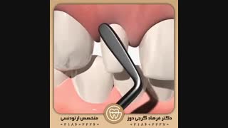 مشکلات دندان های لترال | دکتر فرهاد گرجی دوز